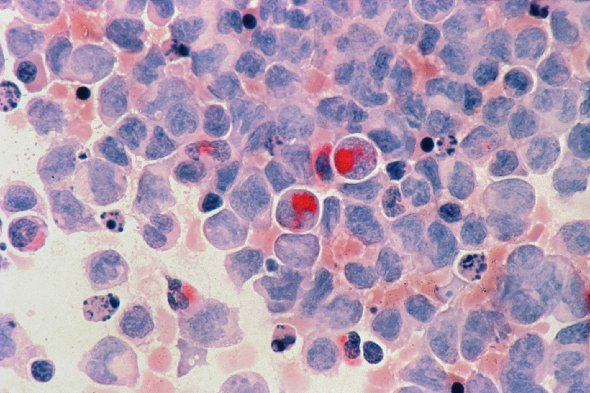 Close up of leukaemia cells