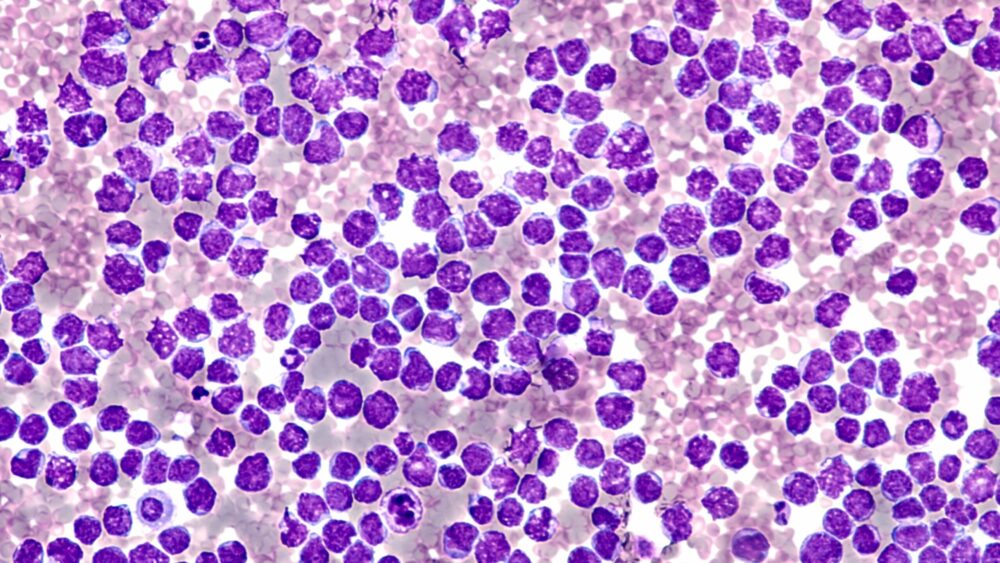 Microscope image of a blood smear showing densely packed purple-stained cells