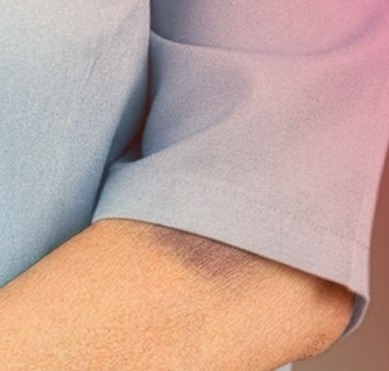close up of an arm with a bruise partially covered by a shirt